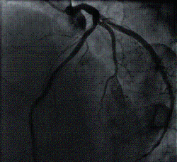 Coronary Angioplasty