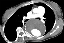 CT scans