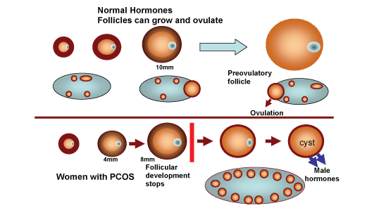 PCOS