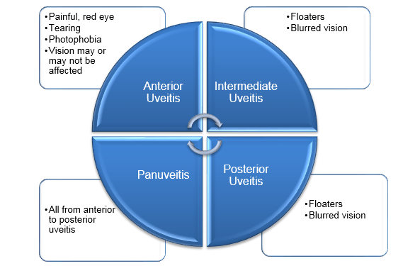 Uveitis symptoms
