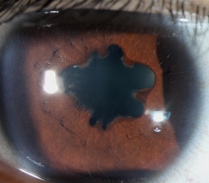 Irregular pupil